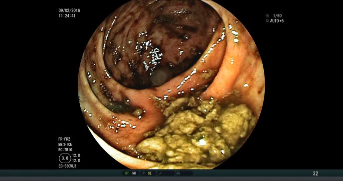 Estudio sugiere que el litio podría prevenir el cáncer intestinal