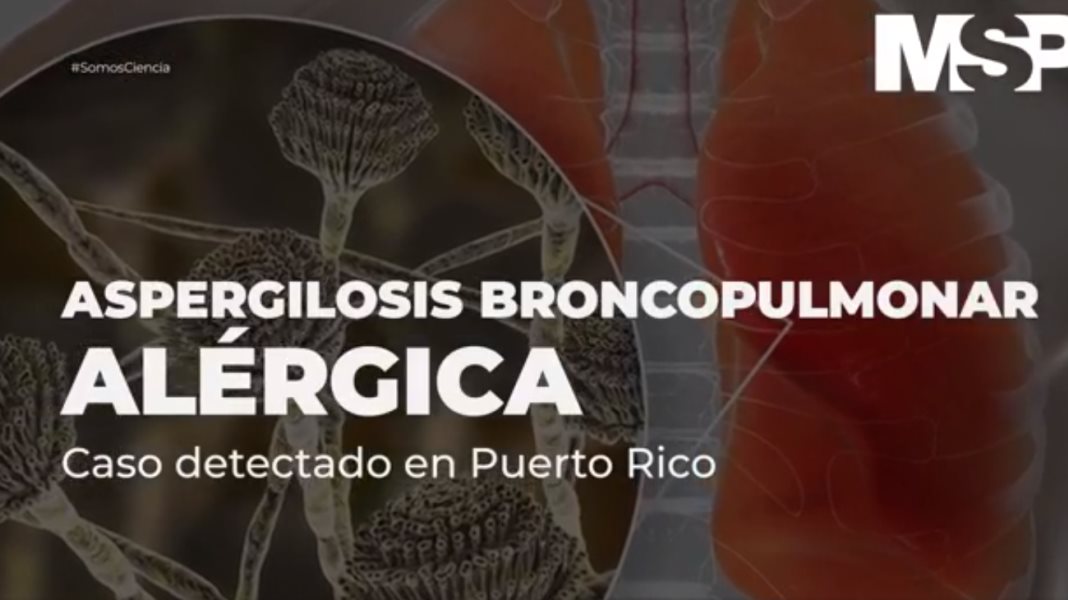 Aspergilosis Pulmonar