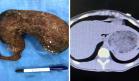 Descubren tumor de cabello humano en el abdomen de joven puertorriqueña 