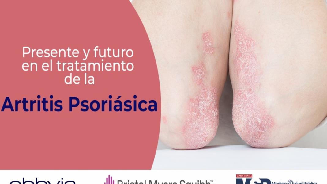Presente y futuro en el tratamiento de la artritis psoriásica
