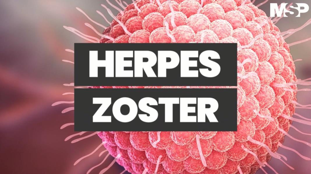 #CápsulaEducativaMSP - Herpes Zóster