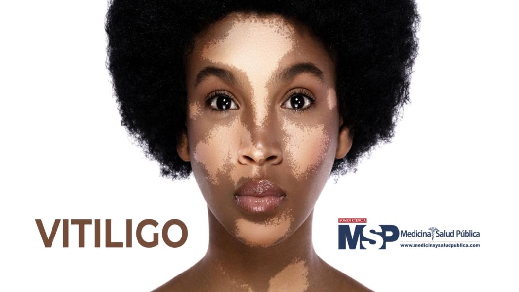 Vitiligo