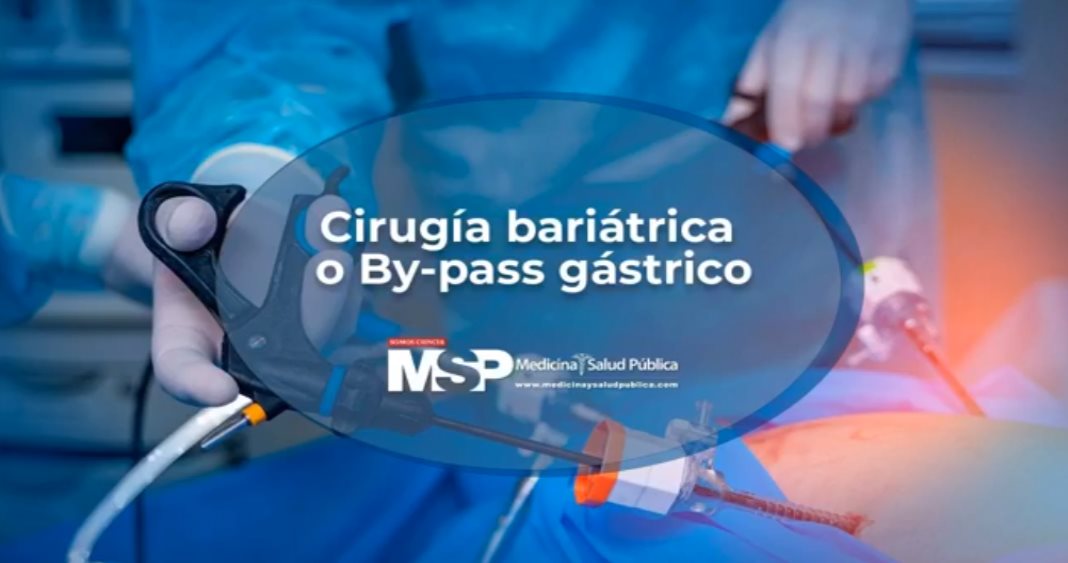 Cirugía bariátrica o By-pass gástrico