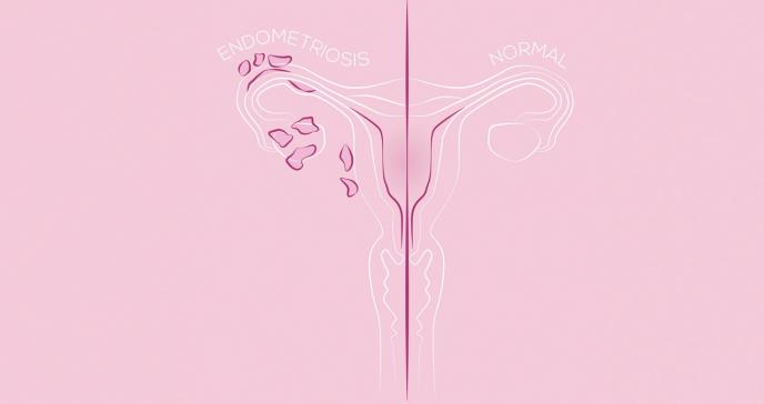 Obesidad y diabetes inciden sobre el cáncer endometrial en mujeres puertorriqueñas