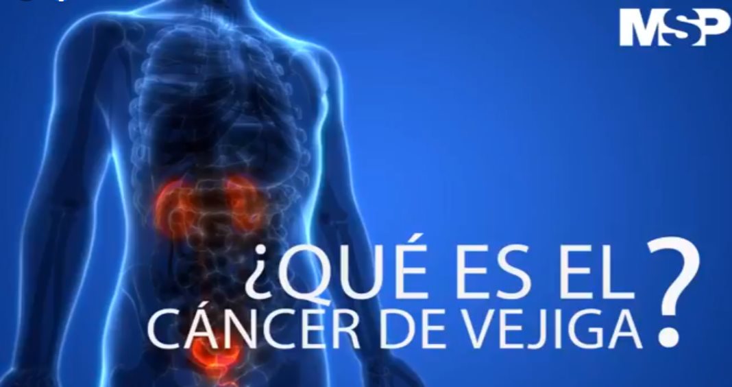 Cáncer de Vejiga