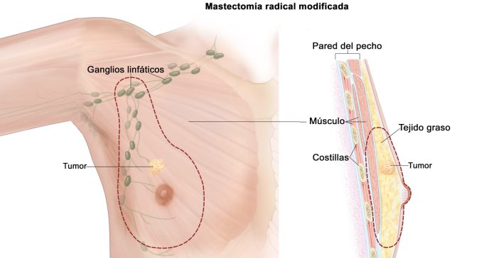 Estímulo hormonal de estrógeno en los hombres aumentaría riesgo de cáncer de mama