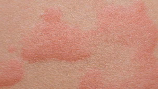 Miel artesanal causa anafilaxia en niño de 5 años Miel artesanal causa anafilaxia en niño de 5 años