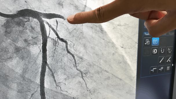 Extraño caso de taquicardia reflejaría enfermedad cardíaca a largo plazo en pacientes con Covid-19