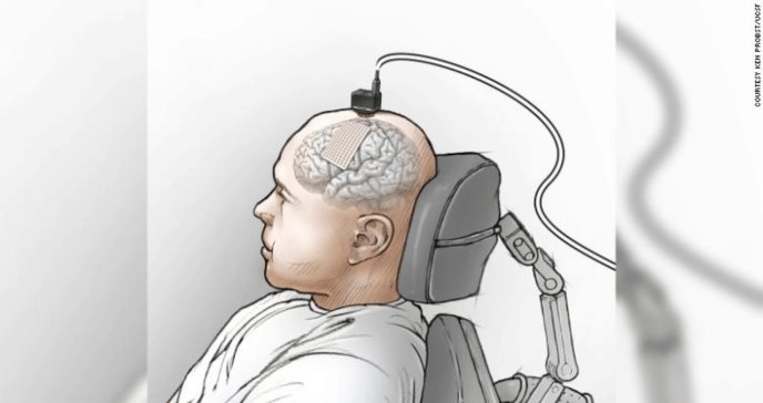 Implante cerebral ayuda a un hombre a hablar a través de una computadora