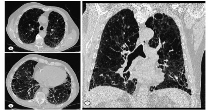 La neumonía intersticial usual en artritis reumatoide se asocia a mayor mortalidad
