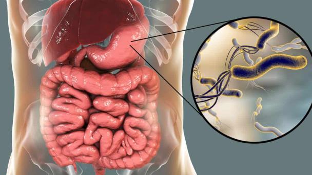 La bacteria Helicobacter Pylori continúa causando enfermedades gástricas en Puerto Rico