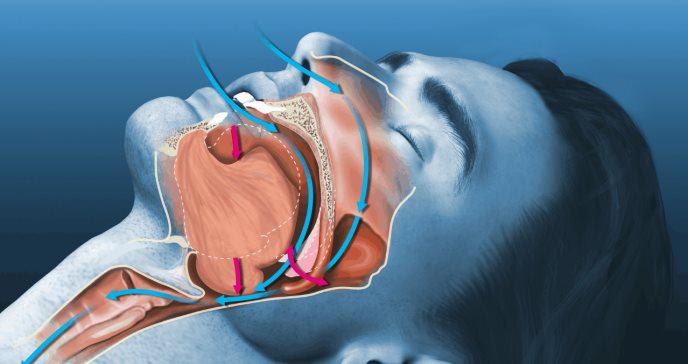La cirugía reduce el riesgo de complicaciones sistémicas en la apnea del sueño