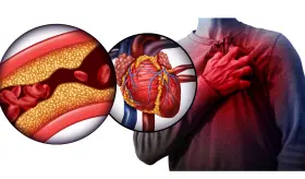 Dolor en el pecho, fatiga y otros síntomas del infarto de miocardio: conoce las causas y su tratamiento