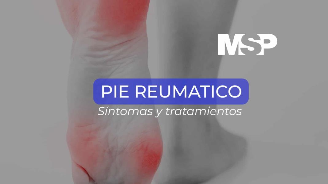 Pie Reumático - Cápsula Educativa