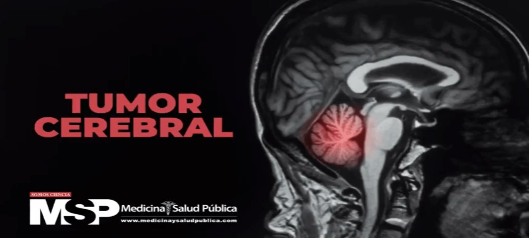 Detección temprana de tumores en el cerebro