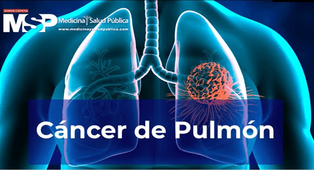 Cáncer de Pulmón - patólogo clínico Marco Alfonso Nieto