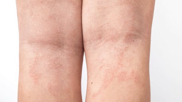Estudio demuestra superioridad de RINVOQ® para tratar la dermatitis atópica Estudio demuestra superioridad de RINVOQ® para tratar la dermatitis atópica
