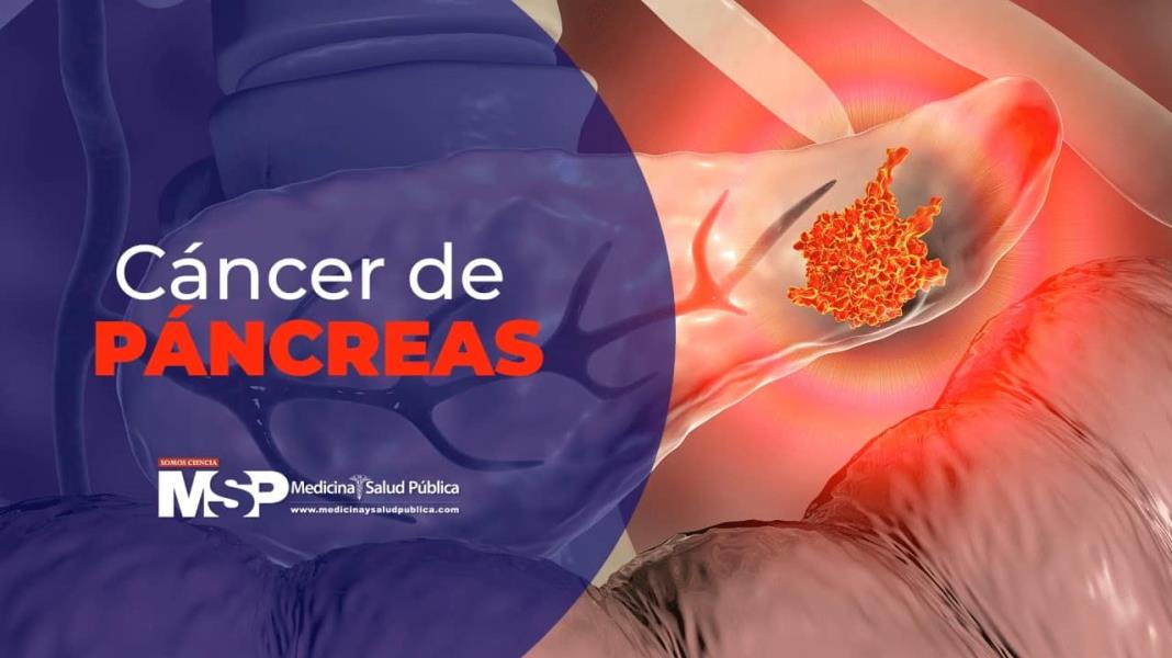 Cáncer de Páncreas - Dr. Luis Fernando Negrete