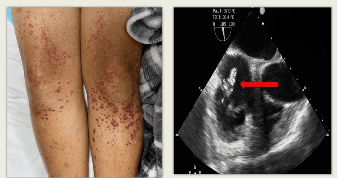 Endocarditis de la válvula tricúspide provoca extraño tipo de vasculitis leucocitoclásticas en paciente