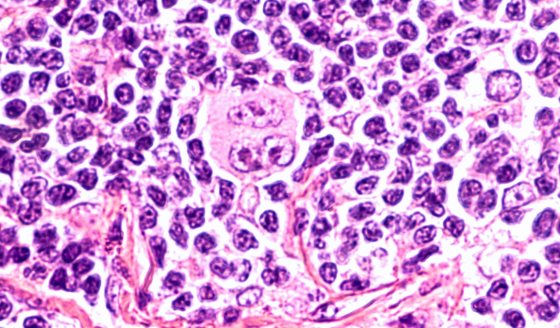 ¿Cuáles son las causas de linfoma?