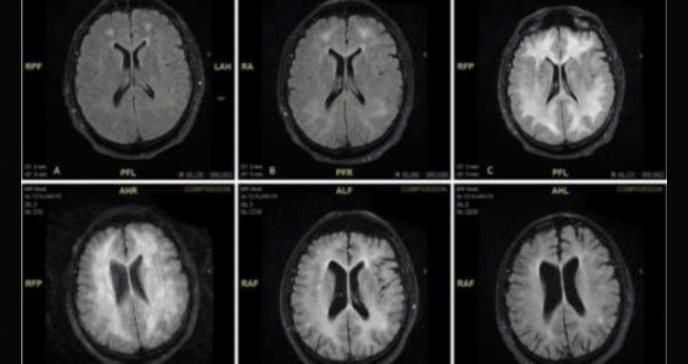 Científicos puertorriqueños continúan evidenciando efectos de la cocaína en el cerebro 