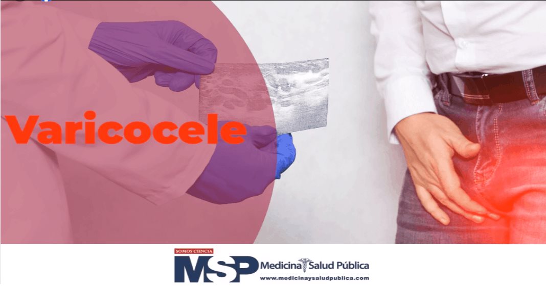 Varicocele: síntomas y diagnóstico