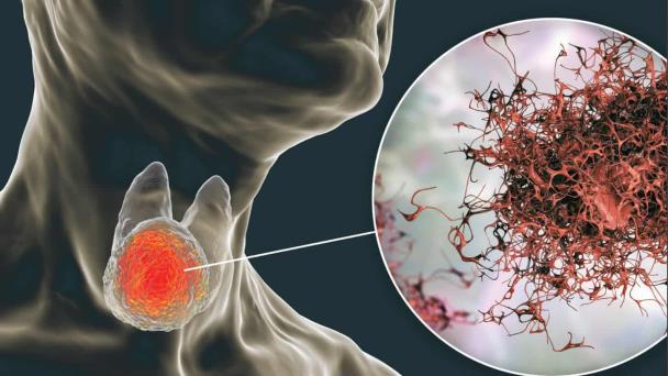 Incidencia de cáncer de tiroides en Puerto Rico y EEUU por grupo racial / étnico Incidencia de cáncer de tiroides en Puerto Rico y EEUU por grupo racial / étnico