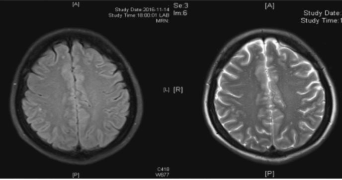 Paciente con síndrome de Sjogren registra infección causada por hongo en pulmones y en zona ósea