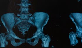 Tratamiento de inmunomoduladores en Mieloma Múltiple