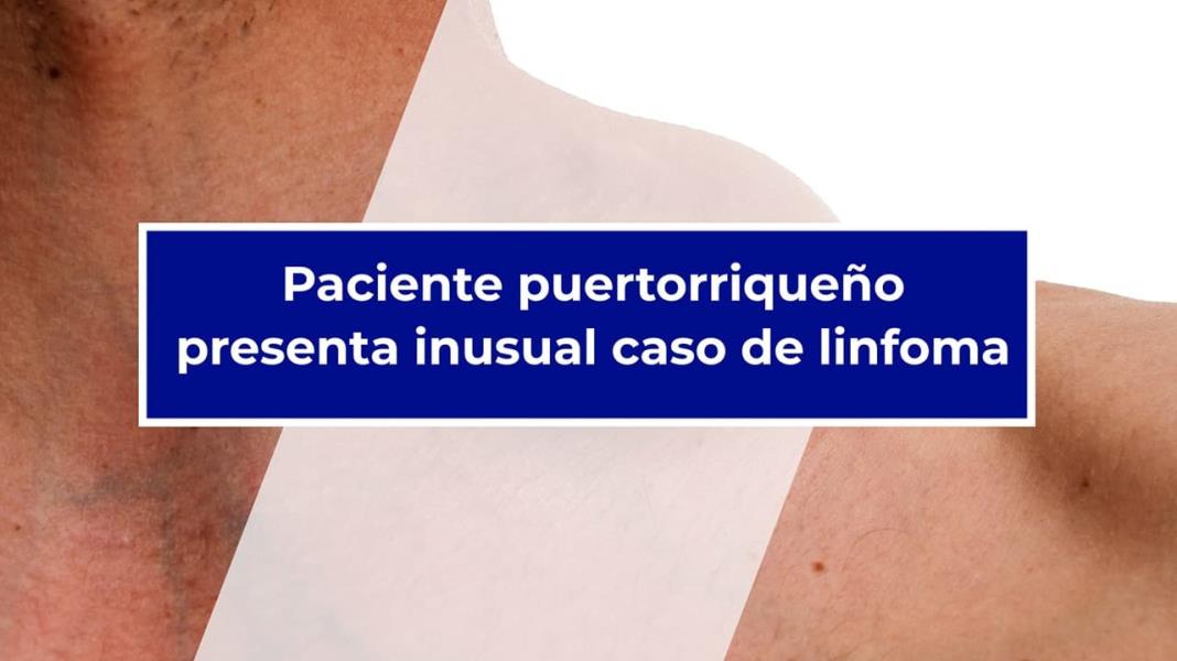 #CasoClínico - Paciente puertorriqueño presenta inusual caso de Linfoma