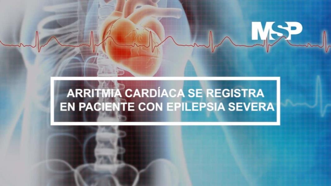 Arritmia Cardíaca se registra en Paciente con Epilepsia Severa