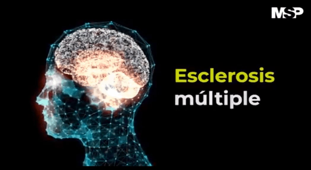 Complicaciones sistémicas de la Esclerosis múltiple - Cápsula Informativa