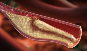 Investigadores confirman la relación entre el colesterol en sangre y riesgo de demencia