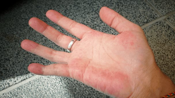¿Qué es el lupus? Estos son sus síntomas y su tratamiento ¿Qué es el lupus? Estos son sus síntomas y su tratamiento
