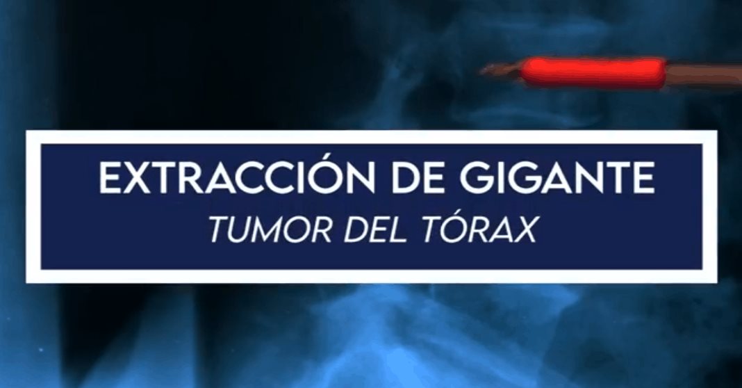 Logran extraer gigante tumor del tórax de una mujer en Puerto Rico contra todo pronóstico