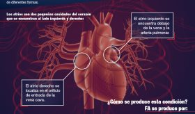 Fibrilación Atrial Infografías