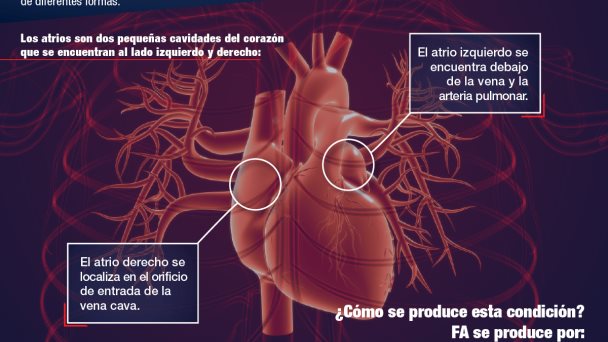 Fibrilación Atrial Infografías