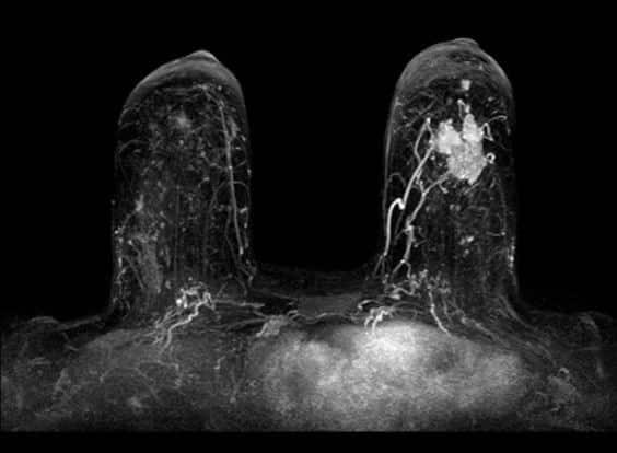 Cáncer de seno: de la epidemiología al tratamiento