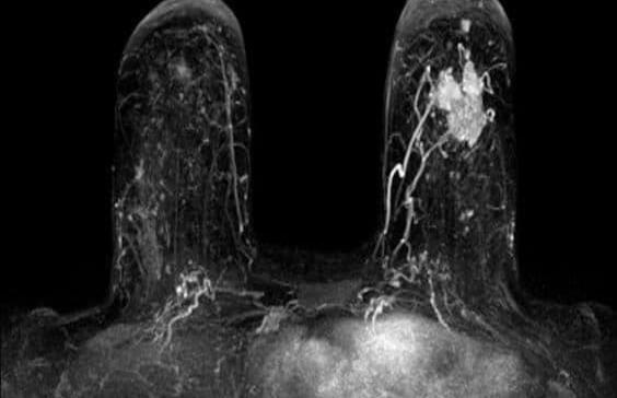 Cáncer de seno: de la epidemiología al tratamiento