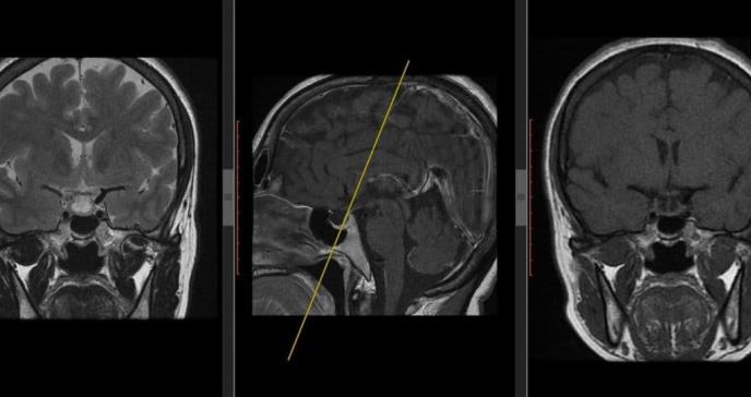 Adenomas hipofisarios dobles con somatotrofo sincrónico y corticotrofo clínico