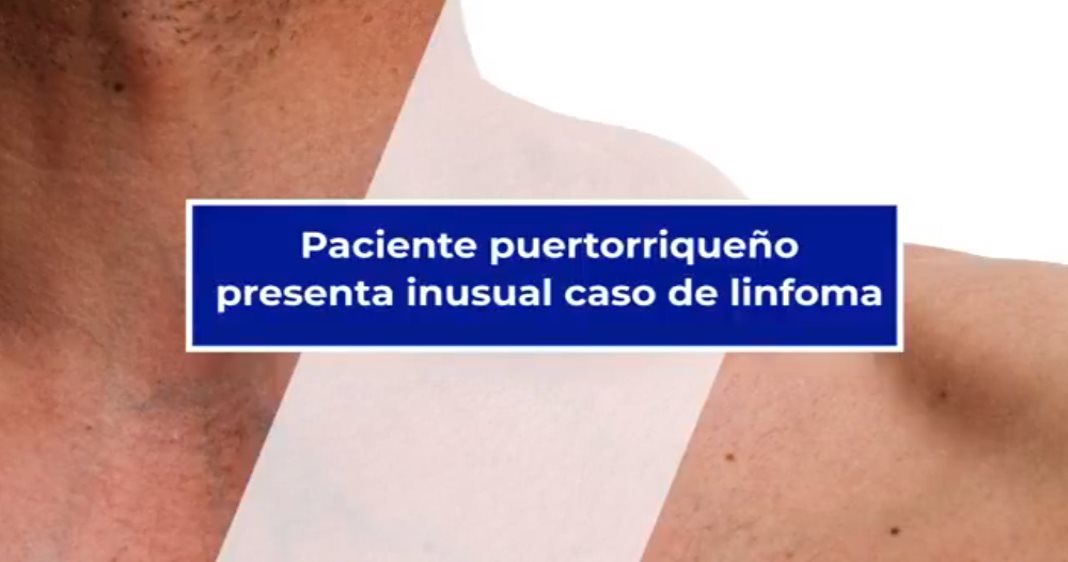 #ExclusivoMSP - Paciente puertorriqueño presenta inusual caso de linfoma