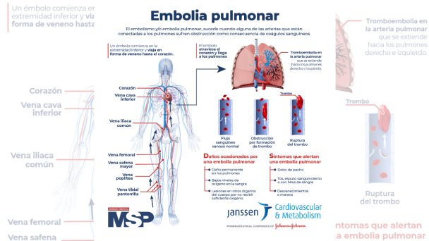 #ExclusivoMSP - Embolia Pulmonar