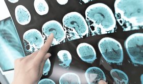 Diagnóstico de Esclerosis Múltiples en el UNSN Comfort luego del Huracán María