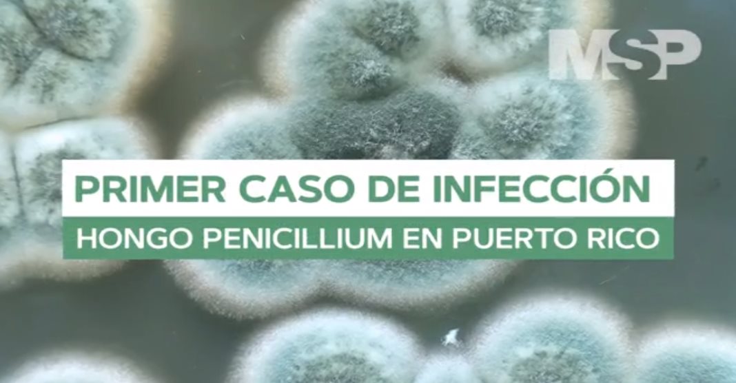 #ExclusivoMSP - Primer caso de infección por hongo penicillum en Puerto Rico