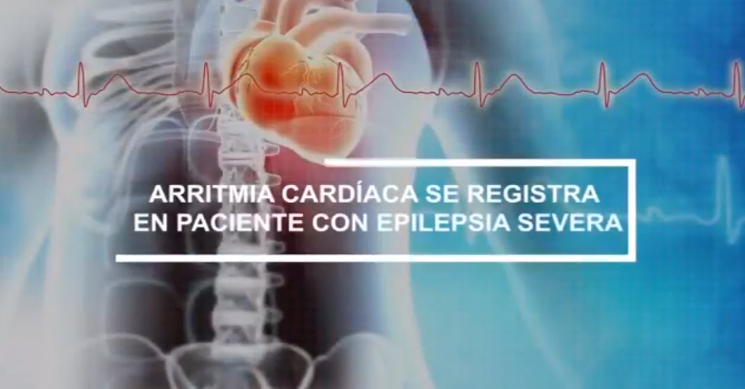 #ExclusivoMSP - Arritmia Cardíaca se registra en Paciente con Epilepsia Severa
