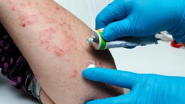 Tratamientos para la psoriasis guttata aguda: exclusión de los fármacos para la infección bacteriana