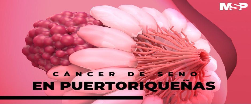 #ExclusivoMSP - Cáncer de seno en Puertorriqueñas