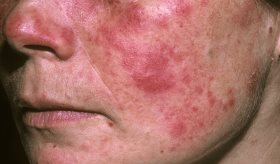 Investigadores revelan una causa genética del lupus