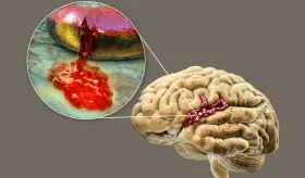 Algunos medicamentos contra la migraña producirían ictus en población envejeciente, según investigación