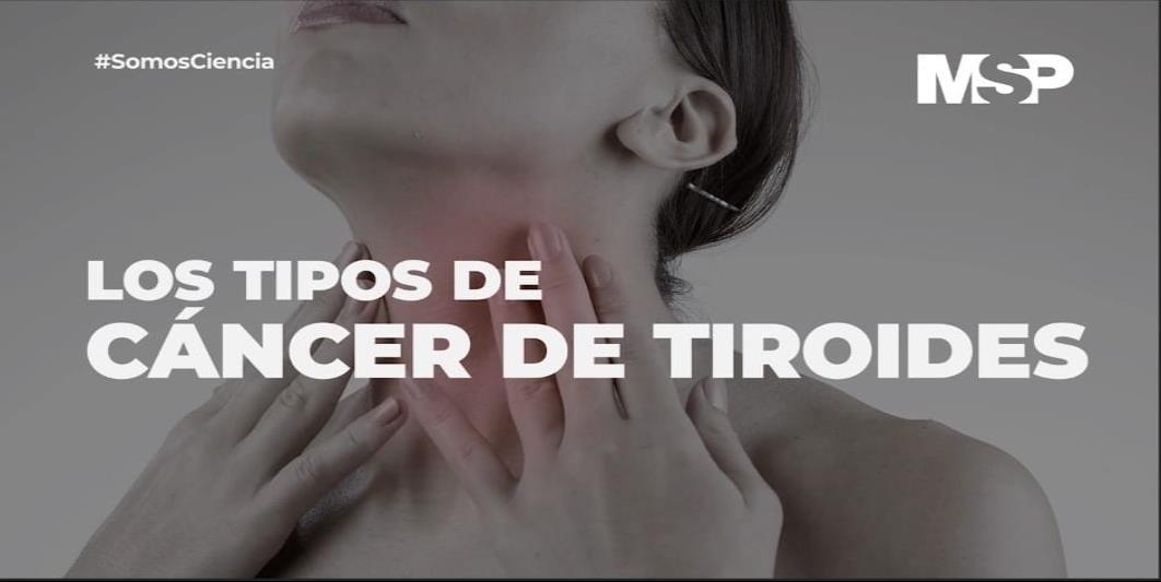 #ExclusivoMSP - Tipos de Cáncer de Tiroides